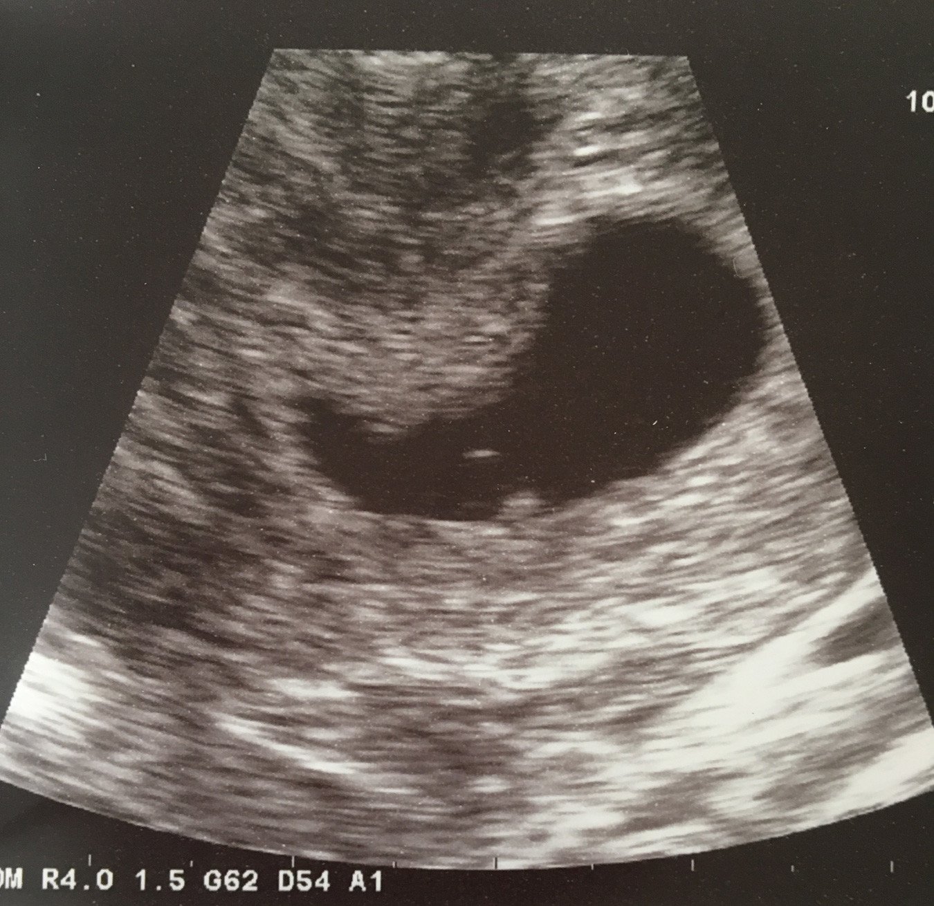 5 week ultrasound