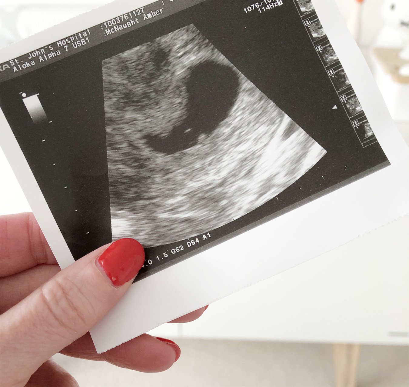 1st ultrasound scan