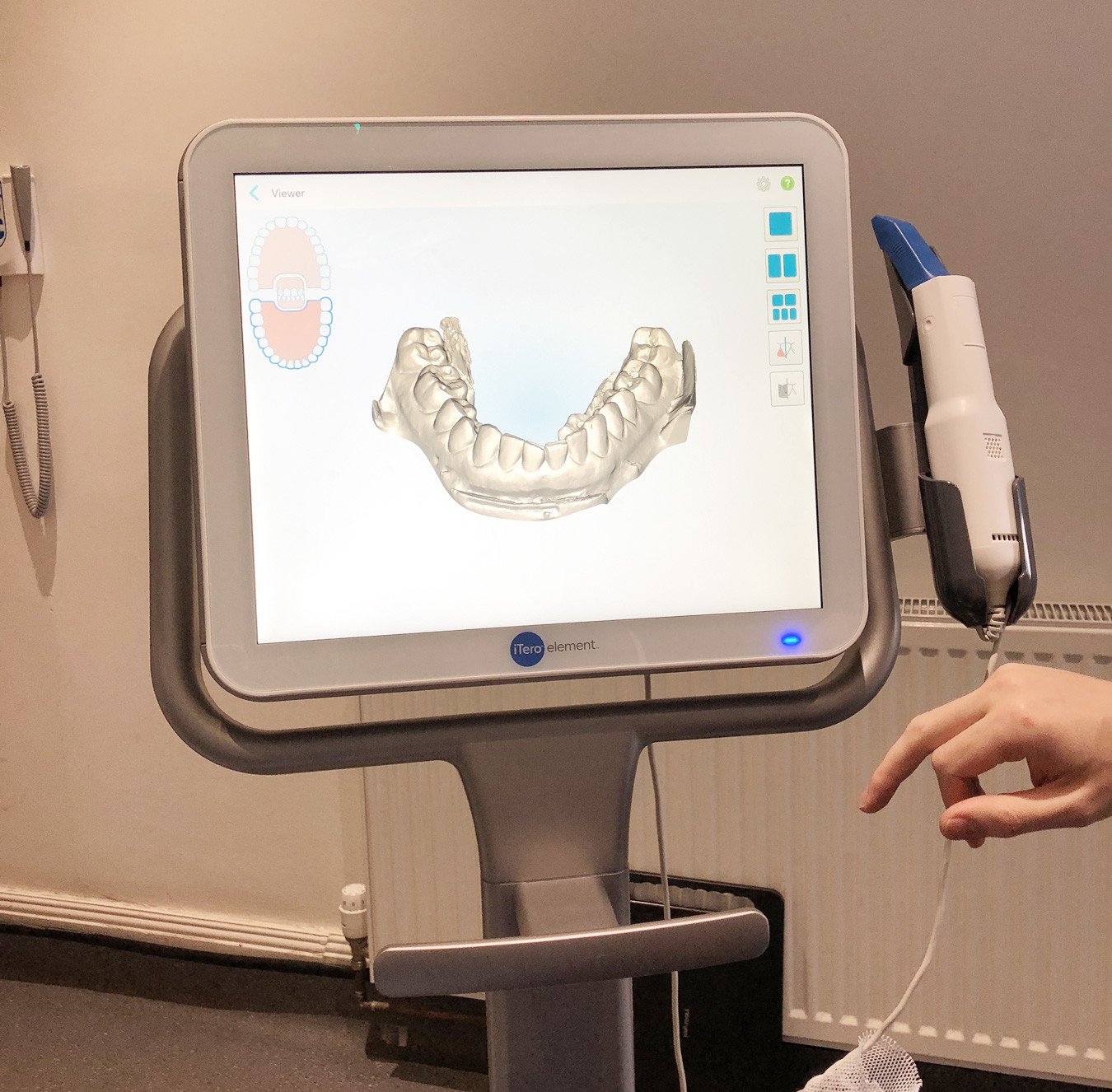 laser scanner for dental impressions: ideal for people who are scared of the dentist